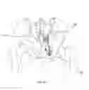 Fig. 216 - Methods of fusing a sacroiliac joint with a fluted screw delivered across the sacroiliac joint