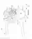 Fig. 53 - Methods of fusing a sacroiliac joint with a fluted screw delivered across the sacroiliac joint