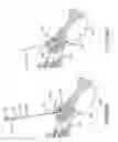 Fig. 56 - Methods of fusing a sacroiliac joint with a fluted screw delivered across the sacroiliac joint
