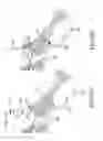 Fig. 57 - Methods of fusing a sacroiliac joint with a fluted screw delivered across the sacroiliac joint