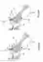 Fig. 58 - Methods of fusing a sacroiliac joint with a fluted screw delivered across the sacroiliac joint