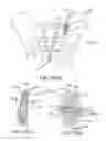 Fig. 70 - Methods of fusing a sacroiliac joint with a fluted screw delivered across the sacroiliac joint