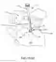 Fig. 72 - Methods of fusing a sacroiliac joint with a fluted screw delivered across the sacroiliac joint
