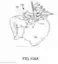 Fig. 74 - Methods of fusing a sacroiliac joint with a fluted screw delivered across the sacroiliac joint