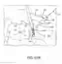 Fig. 77 - Methods of fusing a sacroiliac joint with a fluted screw delivered across the sacroiliac joint