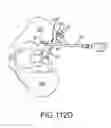 Fig. 85 - Methods of fusing a sacroiliac joint with a fluted screw delivered across the sacroiliac joint