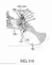 Fig. 87 - Methods of fusing a sacroiliac joint with a fluted screw delivered across the sacroiliac joint