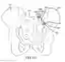 Fig. 89 - Methods of fusing a sacroiliac joint with a fluted screw delivered across the sacroiliac joint