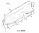 Fig. 93 - Methods of fusing a sacroiliac joint with a fluted screw delivered across the sacroiliac joint