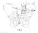 Fig. 02 - Methods of fusing a sacroiliac joint with a threaded joint fixation screw having a plurality of openings therein