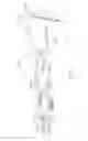 Fig. 201 - Methods of fusing a sacroiliac joint with a threaded joint fixation screw having a plurality of openings therein