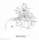 Fig. 82 - Methods of fusing a sacroiliac joint with a threaded joint fixation screw having a plurality of openings therein