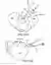 Fig. 83 - Methods of fusing a sacroiliac joint with a threaded joint fixation screw having a plurality of openings therein