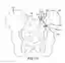 Fig. 89 - Methods of fusing a sacroiliac joint with a threaded joint fixation screw having a plurality of openings therein