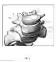 Fig. 06 - Endoscopically implantable inflatable interbody fusion device
