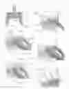 Fig. 06 - Expandable intervertebral implant