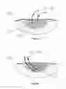 Fig. 22 - Apparatus for aspirating, irrigating and cleansing wounds
