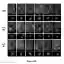 Fig. 17 - Micro-RNA for the treatment of malignant solid tumors and metastasis