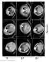 Fig. 19 - Micro-RNA for the treatment of malignant solid tumors and metastasis