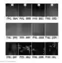 Fig. 27 - Amniotic membrane preparations and purified compositions and therapy for scar reversal and inhibition