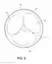 Fig. 03 - IMPLANTABLE INTRAVASCULAR VENTRICULAR ASSIST DEVICE