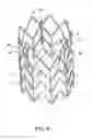 Fig. 07 - IMPLANTABLE INTRAVASCULAR VENTRICULAR ASSIST DEVICE