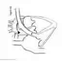 Fig. 10 - Atraumatic medical device