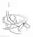 Fig. 22 - Atraumatic medical device