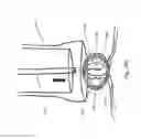 Fig. 22 - Steering engagement catheter devices, systems, and methods