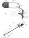 Fig. 02 - System and method for treatment of pulmonary edema