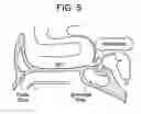 Fig. 05 - Intranasal Insert for OFC Neuroprotection