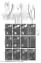 Fig. 09 - Methods of treating brain edema