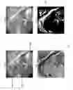 Fig. 09 - System and method for intraoperative detection of cancer margins using conformal filters in a dual polarization configuration