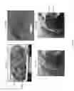 Fig. 11 - System and method for intraoperative detection of cancer margins using conformal filters in a dual polarization configuration