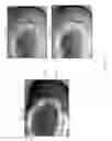 Fig. 12 - System and method for intraoperative detection of cancer margins using conformal filters in a dual polarization configuration