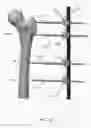Fig. 03 - External fixator assembly
