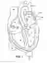 Fig. 06 - Selective Stiffening Catheter