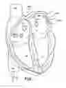 Fig. 07 - Selective Stiffening Catheter