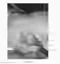 Fig. 20 - Surgical implant for marking soft tissue