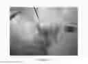 Fig. 23 - Surgical implant for marking soft tissue