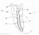Fig. 01 - DENTAL IMPLANTATION DEVICE