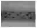 Fig. 01 - GINGIVAL RETRACTION CORD USING MICROFIBER