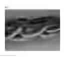 Fig. 02 - GINGIVAL RETRACTION CORD USING MICROFIBER