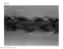 Fig. 03 - GINGIVAL RETRACTION CORD USING MICROFIBER