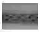 Fig. 06 - GINGIVAL RETRACTION CORD USING MICROFIBER