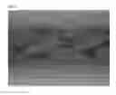 Fig. 08 - GINGIVAL RETRACTION CORD USING MICROFIBER