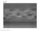 Fig. 09 - GINGIVAL RETRACTION CORD USING MICROFIBER