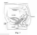 Fig. 06 - Sacrocolpopexy support
