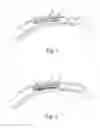 Fig. 02 - Orthopedic implant
