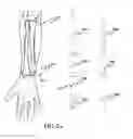 Fig. 03 - Prosthesis for distal radioulnar joint